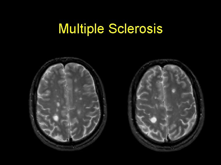 Multiple Sclerosis 