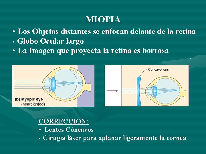 MIOPIA • Los Objetos distantes se enfocan delante de la retina • Globo Ocular MIOPIA • Los Objetos distantes se enfocan delante de la retina • Globo Ocular