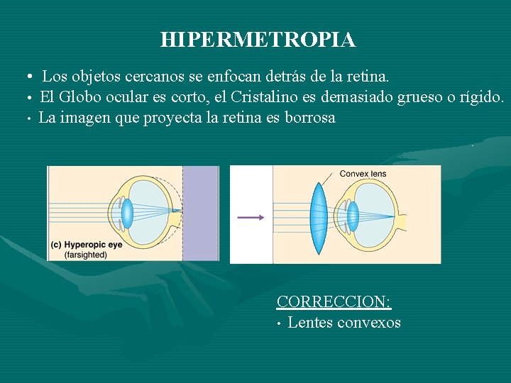 HIPERMETROPIA • Los objetos cercanos se enfocan detrás de la retina. • El Globo HIPERMETROPIA • Los objetos cercanos se enfocan detrás de la retina. • El Globo