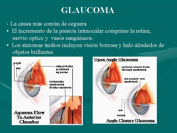 GLAUCOMA La causa más común de ceguera • El incremento de la presión intraocular GLAUCOMA La causa más común de ceguera • El incremento de la presión intraocular