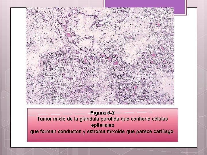 Figura 6 -2 Tumor mixto de la glándula parótida que contiene células epiteliales que
