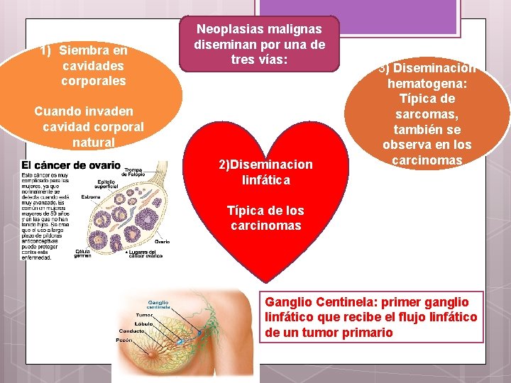 1) Siembra en cavidades corporales Neoplasias malignas diseminan por una de tres vías: Cuando