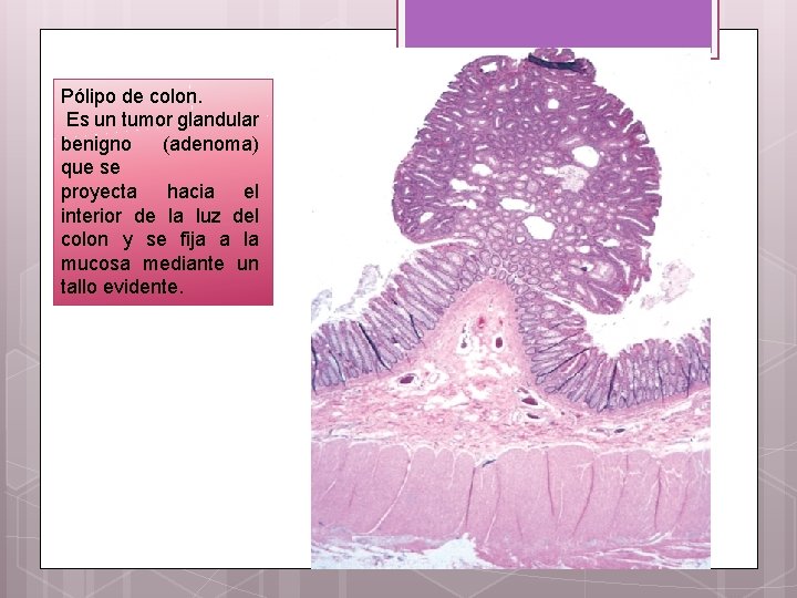 Pólipo de colon. Es un tumor glandular benigno (adenoma) que se proyecta hacia el