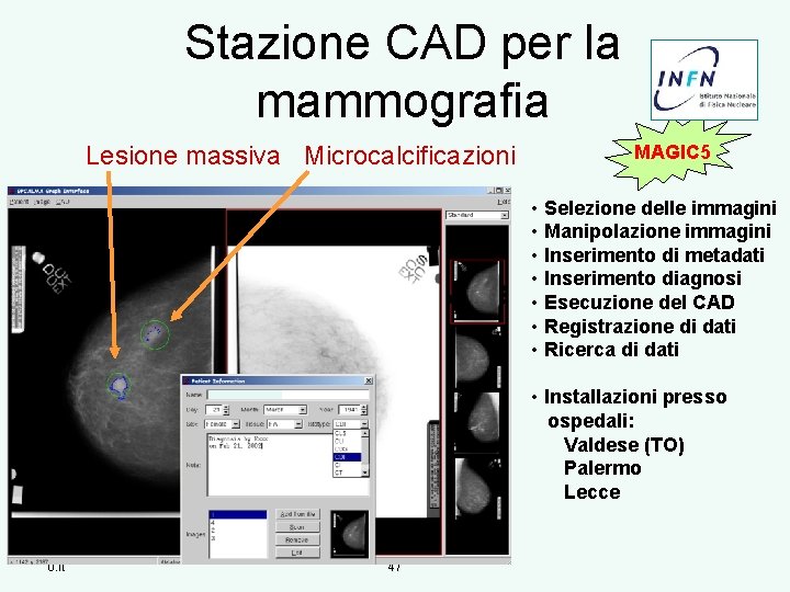 Stazione CAD per la mammografia Lesione massiva Microcalcificazioni MAGIC 5 • Selezione delle immagini