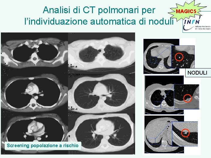 MAGIC 5 Analisi di CT polmonari per l’individuazione automatica di noduli NODULI Screening popolazione