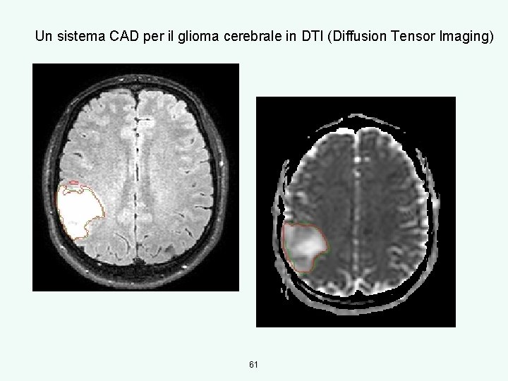 Un sistema CAD per il glioma cerebrale in DTI (Diffusion Tensor Imaging) 61 