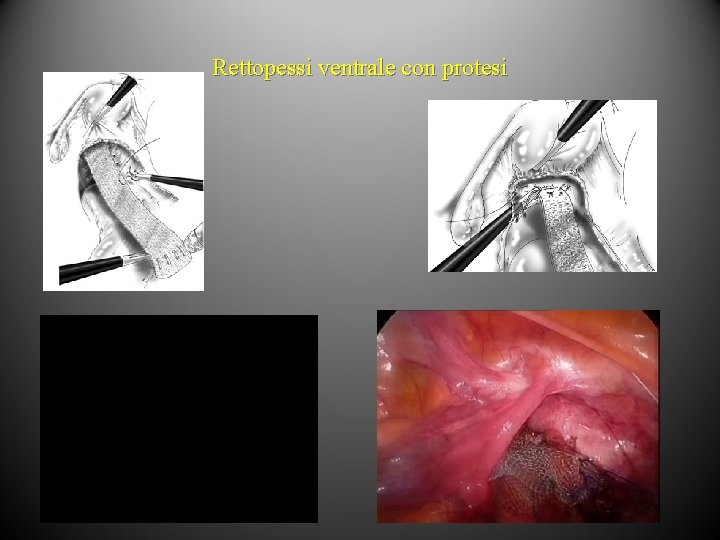 Rettopessi ventrale con protesi 