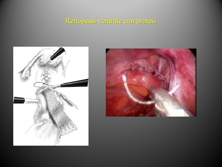 Rettopessi ventrale con protesi 
