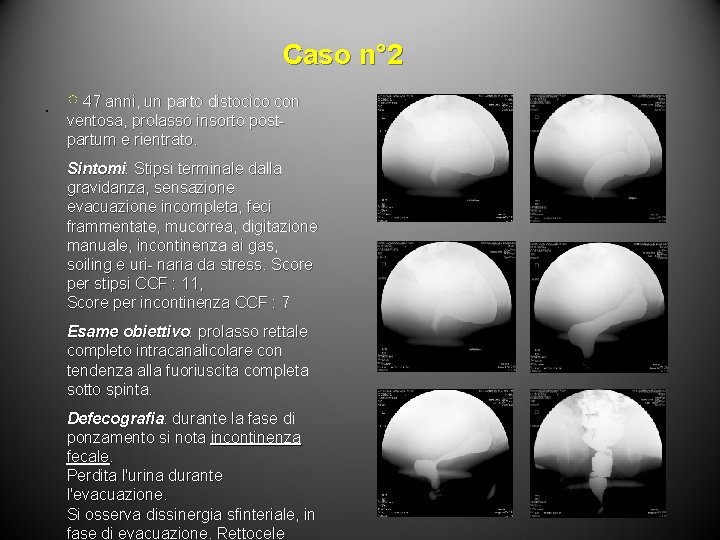 Caso n° 2. ♀ 47 anni, un parto distocico con ventosa, prolasso insorto postpartum