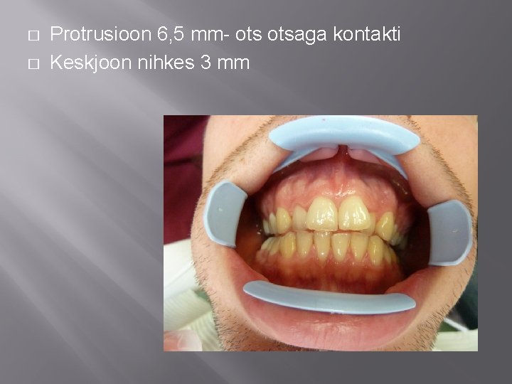 � � Protrusioon 6, 5 mm- otsaga kontakti Keskjoon nihkes 3 mm 