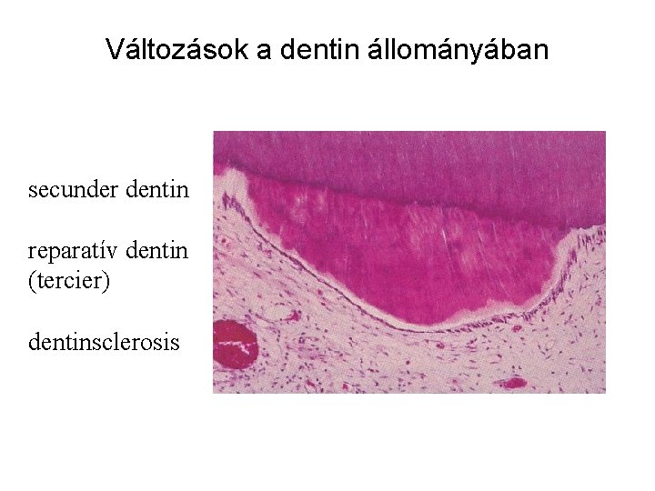 Változások a dentin állományában secunder dentin reparatív dentin (tercier) dentinsclerosis 