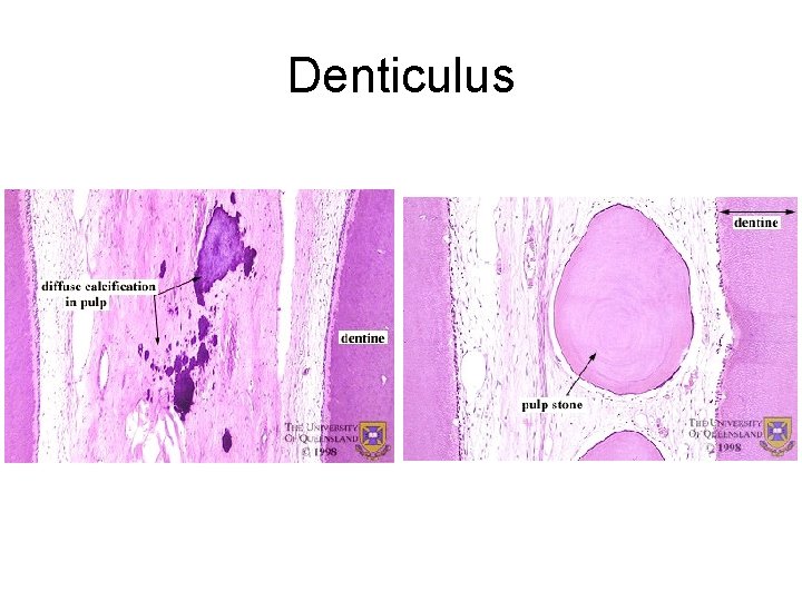 Denticulus 