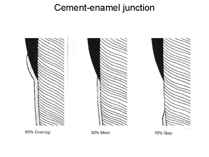 Cement-enamel junction 60% átfed 30% volaban 10% rés 