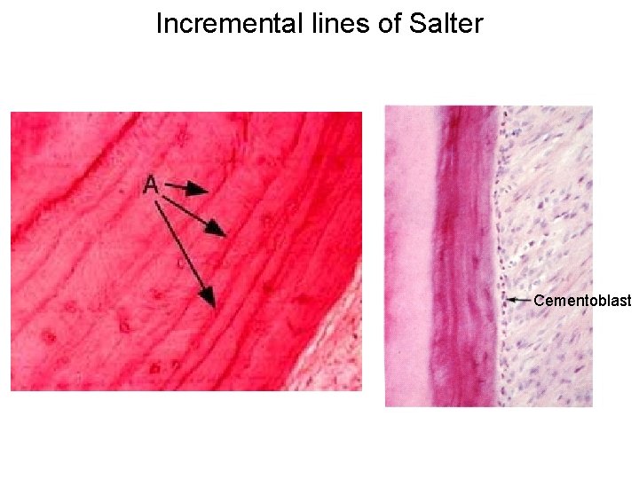 Incremental lines of Salter Cementoblast 