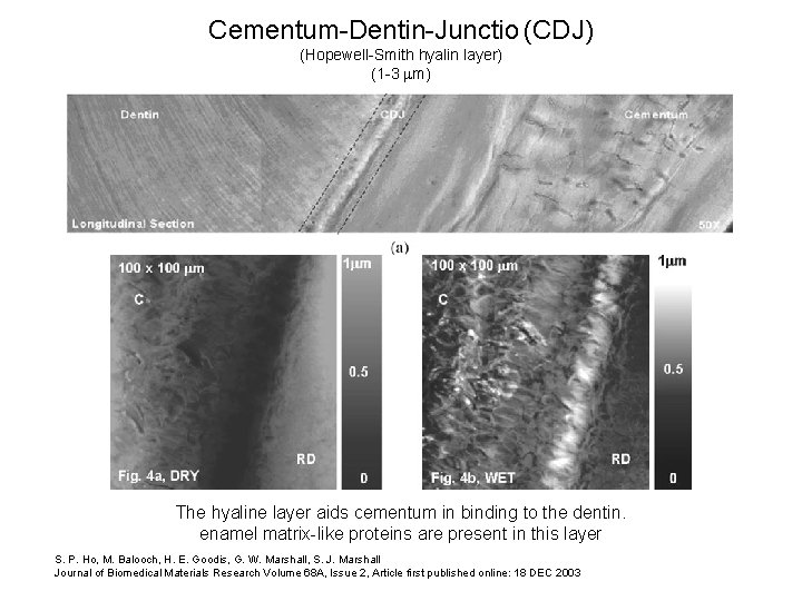 Cementum-Dentin-Junctio (CDJ) (Hopewell-Smith hyalin layer) (1 -3 mm) The hyaline layer aids cementum in