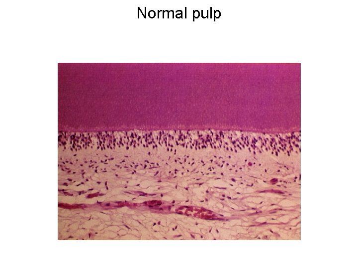 Normal pulp 