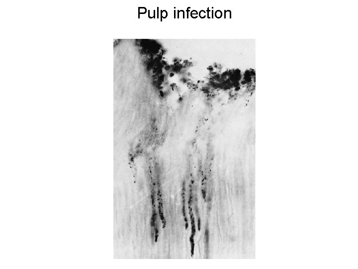 Pulp infection 