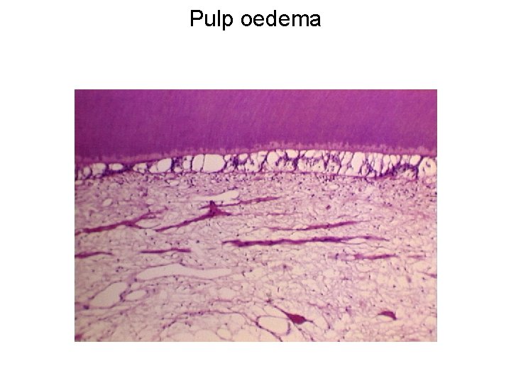 Pulp oedema 