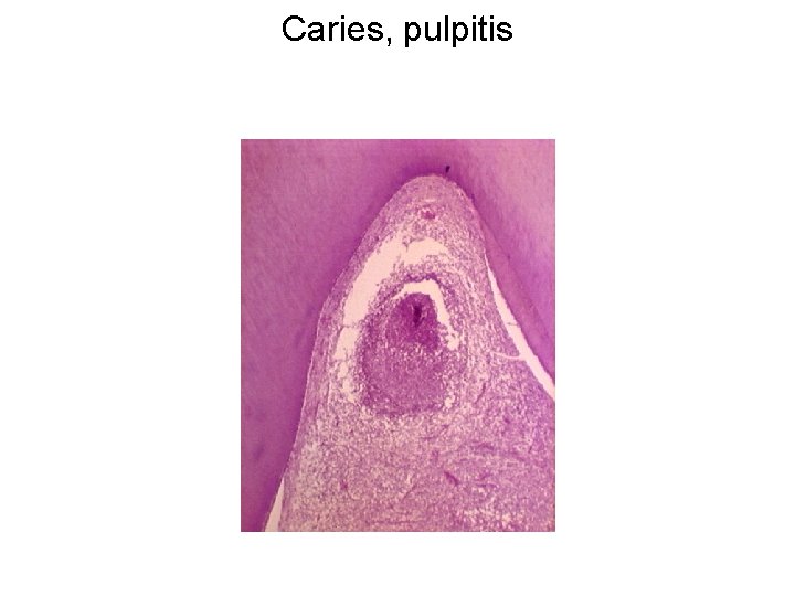 Caries, pulpitis 