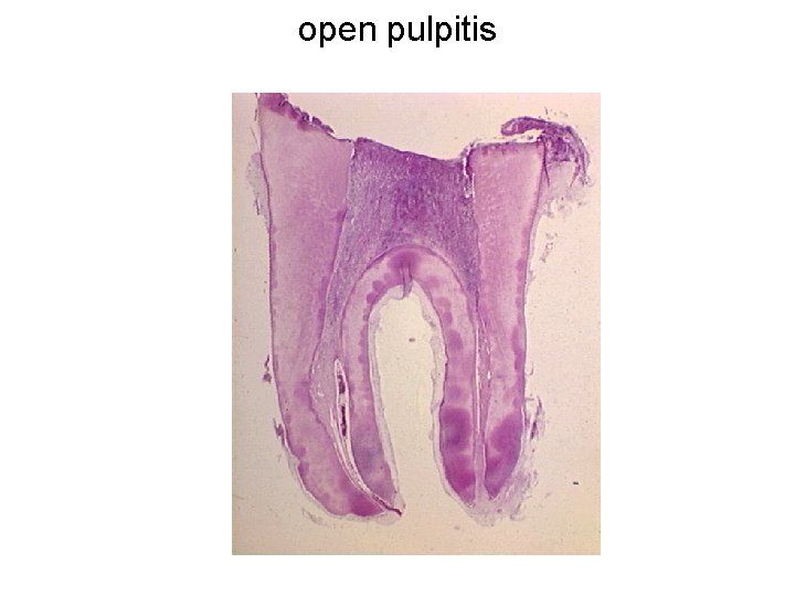 open pulpitis 