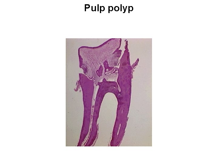 Pulp polyp 