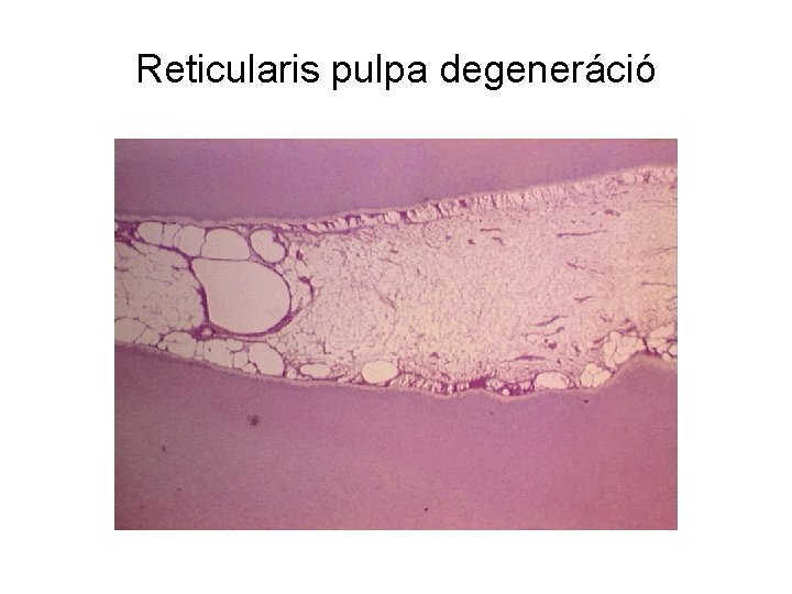 Reticularis pulpa degeneráció 