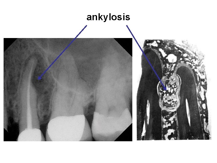 ankylosis 