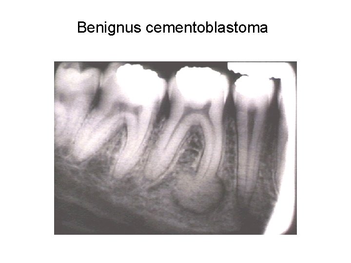 Benignus cementoblastoma 