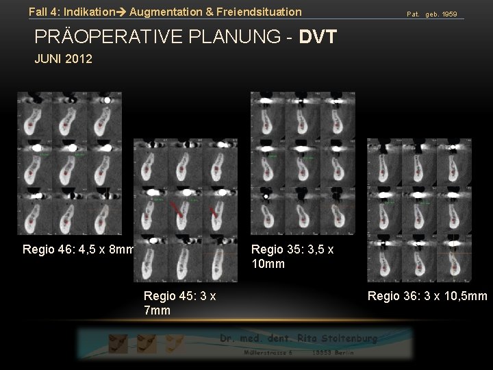 Fall 4: Indikation Augmentation & Freiendsituation Pat. geb. 1959 PRÄOPERATIVE PLANUNG - DVT JUNI