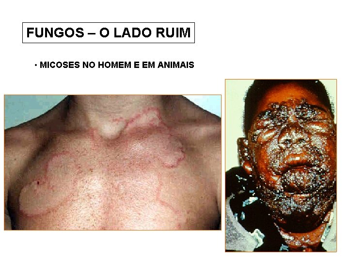 FUNGOS – O LADO RUIM • MICOSES NO HOMEM E EM ANIMAIS 