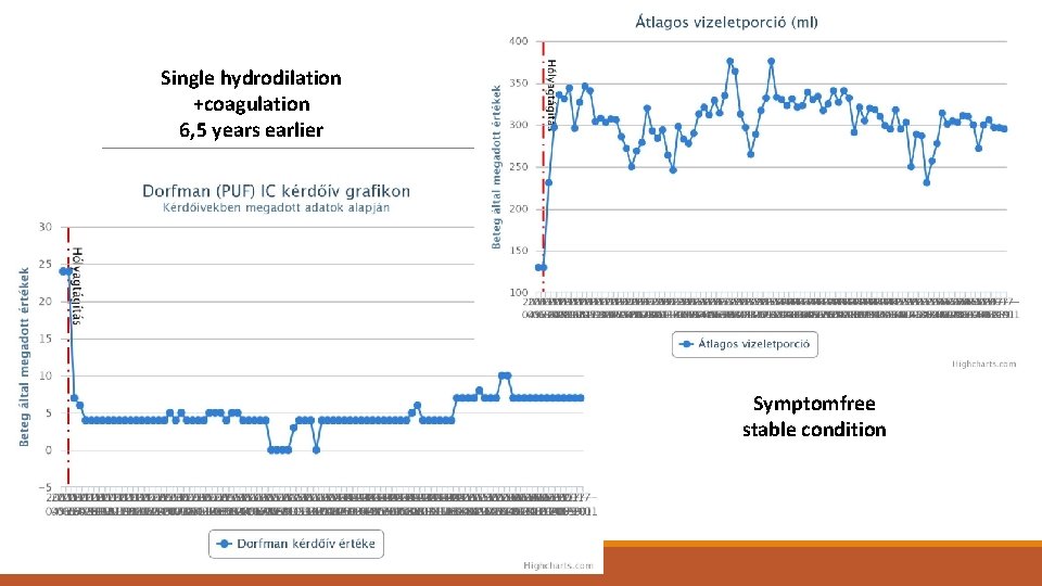 Single hydrodilation +coagulation 6, 5 years earlier Symptomfree stable condition 