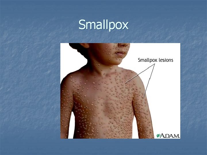 Smallpox 