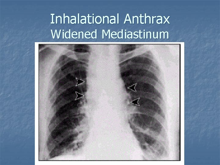 Inhalational Anthrax Widened Mediastinum 