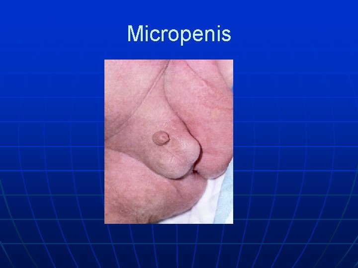 Micropenis 