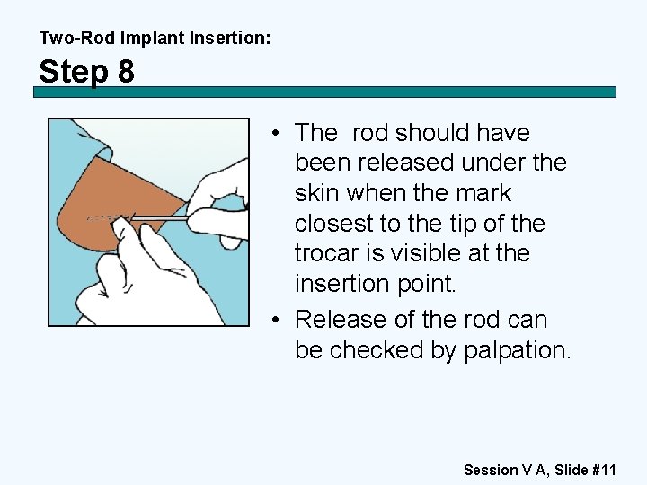 Two-Rod Implant Insertion: Step 8 • The rod should have been released under the