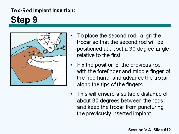 Two-Rod Implant Insertion: Step 9 • To place the second rod , align the