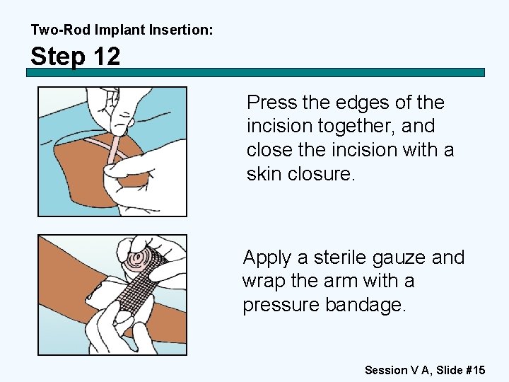 Two-Rod Implant Insertion: Step 12 Press the edges of the incision together, and close