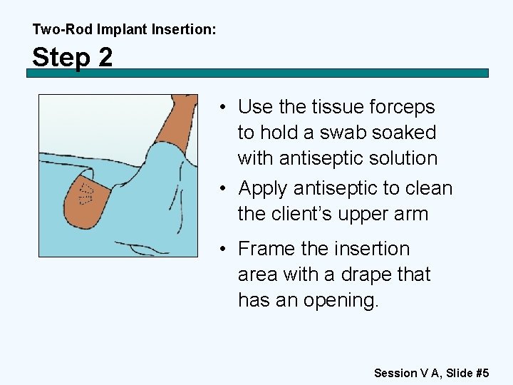 Two-Rod Implant Insertion: Step 2 • Use the tissue forceps to hold a swab