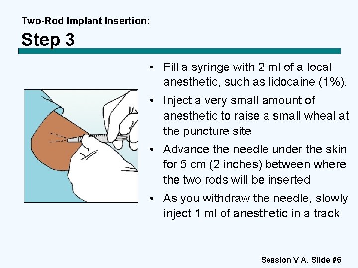 Two-Rod Implant Insertion: Step 3 • Fill a syringe with 2 ml of a