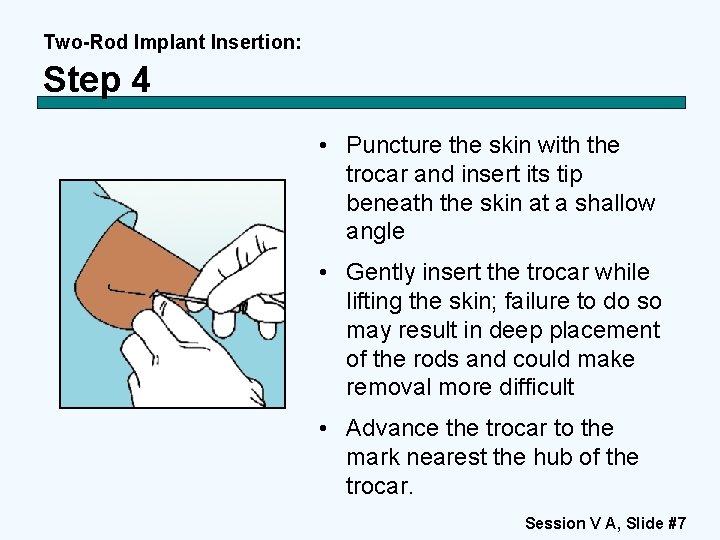 Two-Rod Implant Insertion: Step 4 • Puncture the skin with the trocar and insert