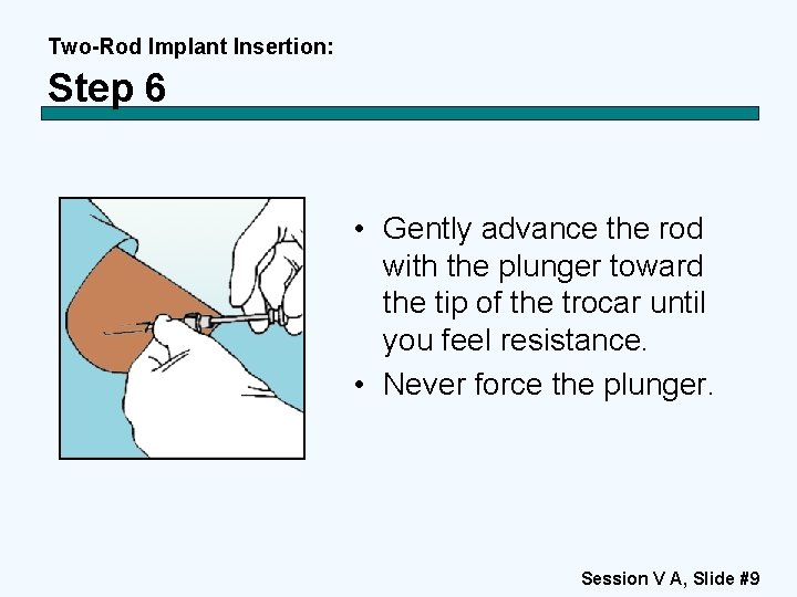 Two-Rod Implant Insertion: Step 6 • Gently advance the rod with the plunger toward