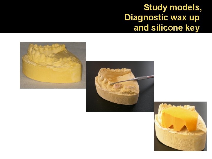 Study models, Diagnostic wax up and silicone key 