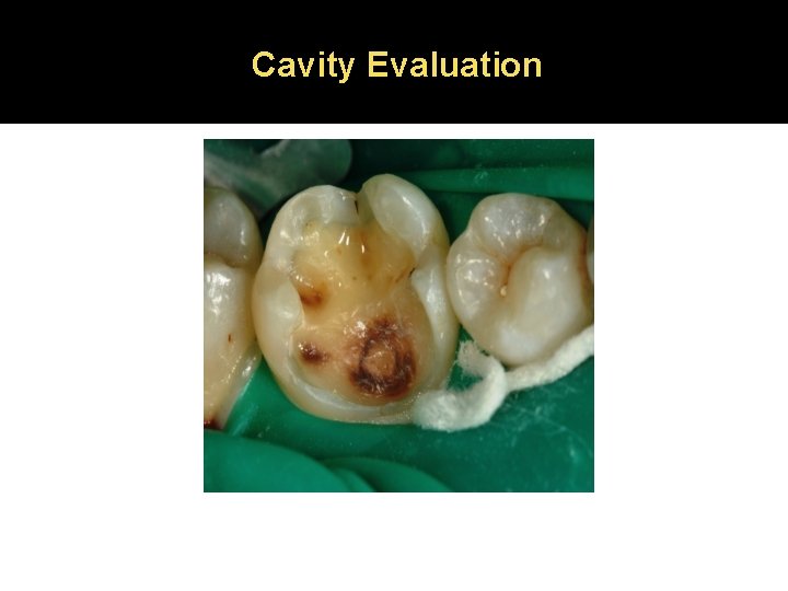 Cavity Evaluation 