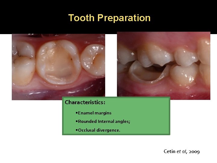 Tooth Preparation Characteristics: Enamel margins Rounded Internal angles; Occlusal divergence. Cetin et al, 2009