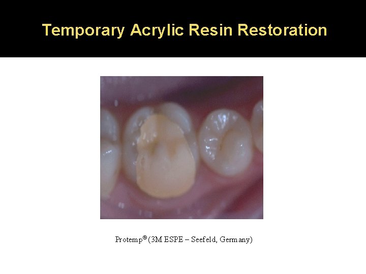 Temporary Acrylic Resin Restoration Protemp® (3 M ESPE – Seefeld, Germany) 