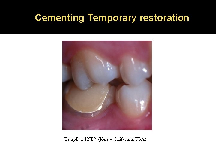 Cementing Temporary restoration Temp. Bond NE® (Kerr – California, USA) 
