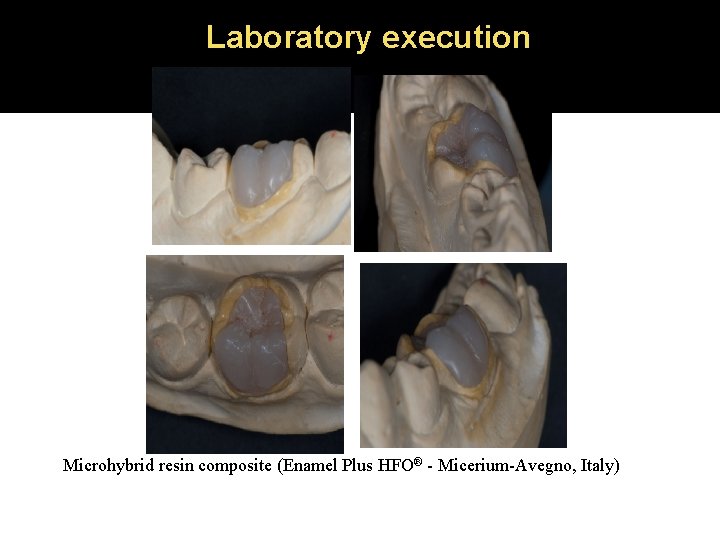 Laboratory execution Microhybrid resin composite (Enamel Plus HFO® - Micerium-Avegno, Italy) 