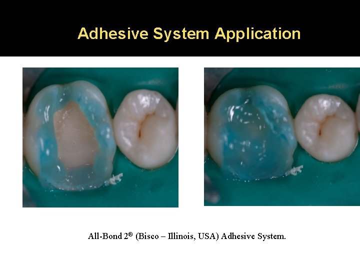 Adhesive System Application All-Bond 2® (Bisco – Illinois, USA) Adhesive System. 