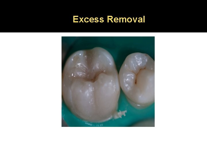 Excess Removal 