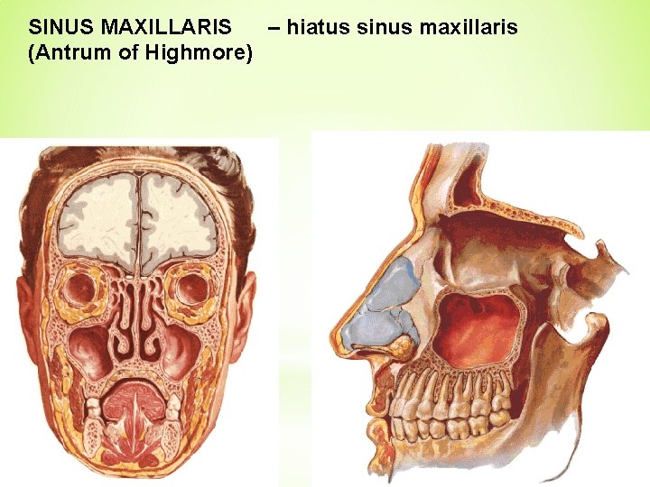 SINUS MAXILLARIS – hiatus sinus maxillaris (Antrum of Highmore) 